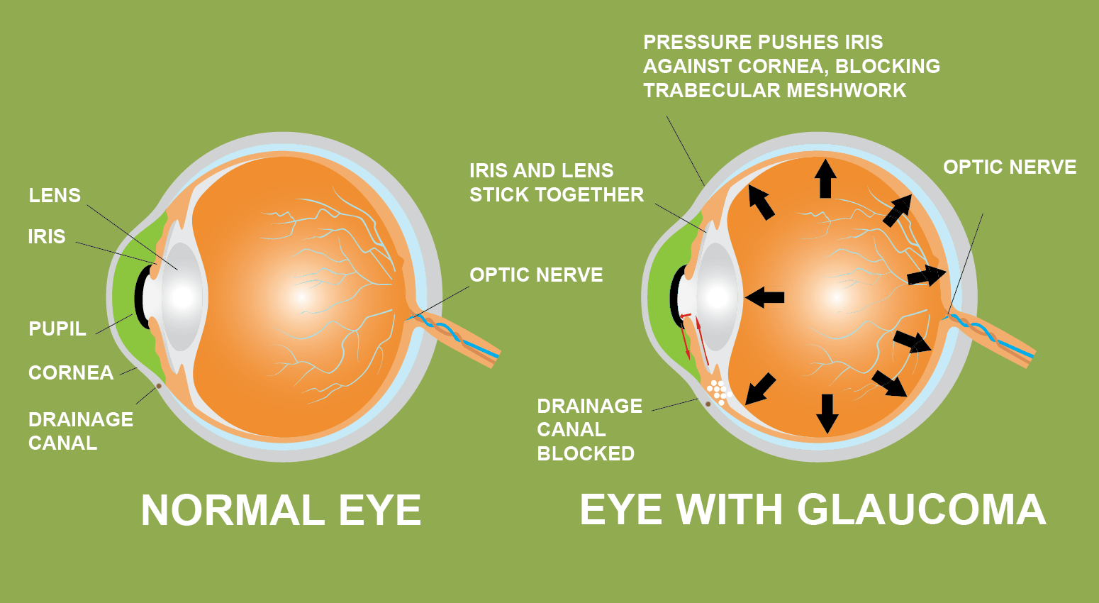 Glaucoma iris lente pupila cornea drenaje canal cannabis prevención