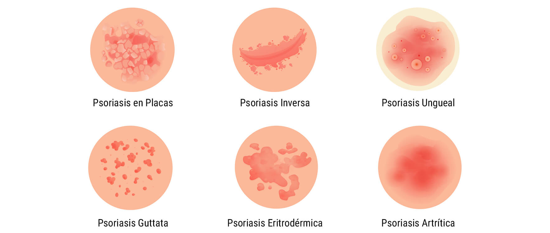¿Qué es la psoriasis? ¿Qué es la psoriasis?
