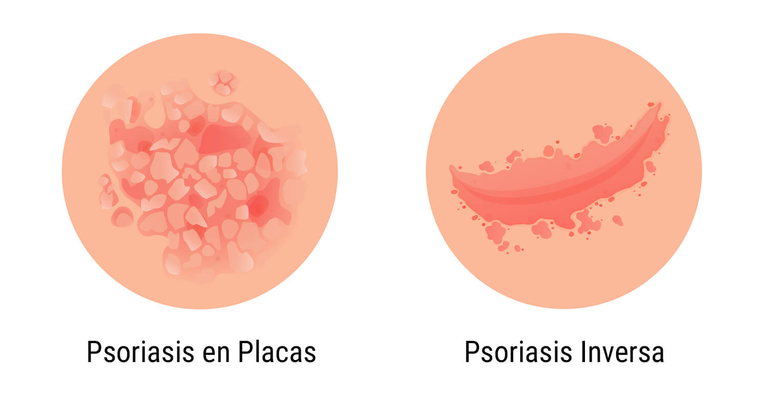 ¿Qué es la psoriasis?