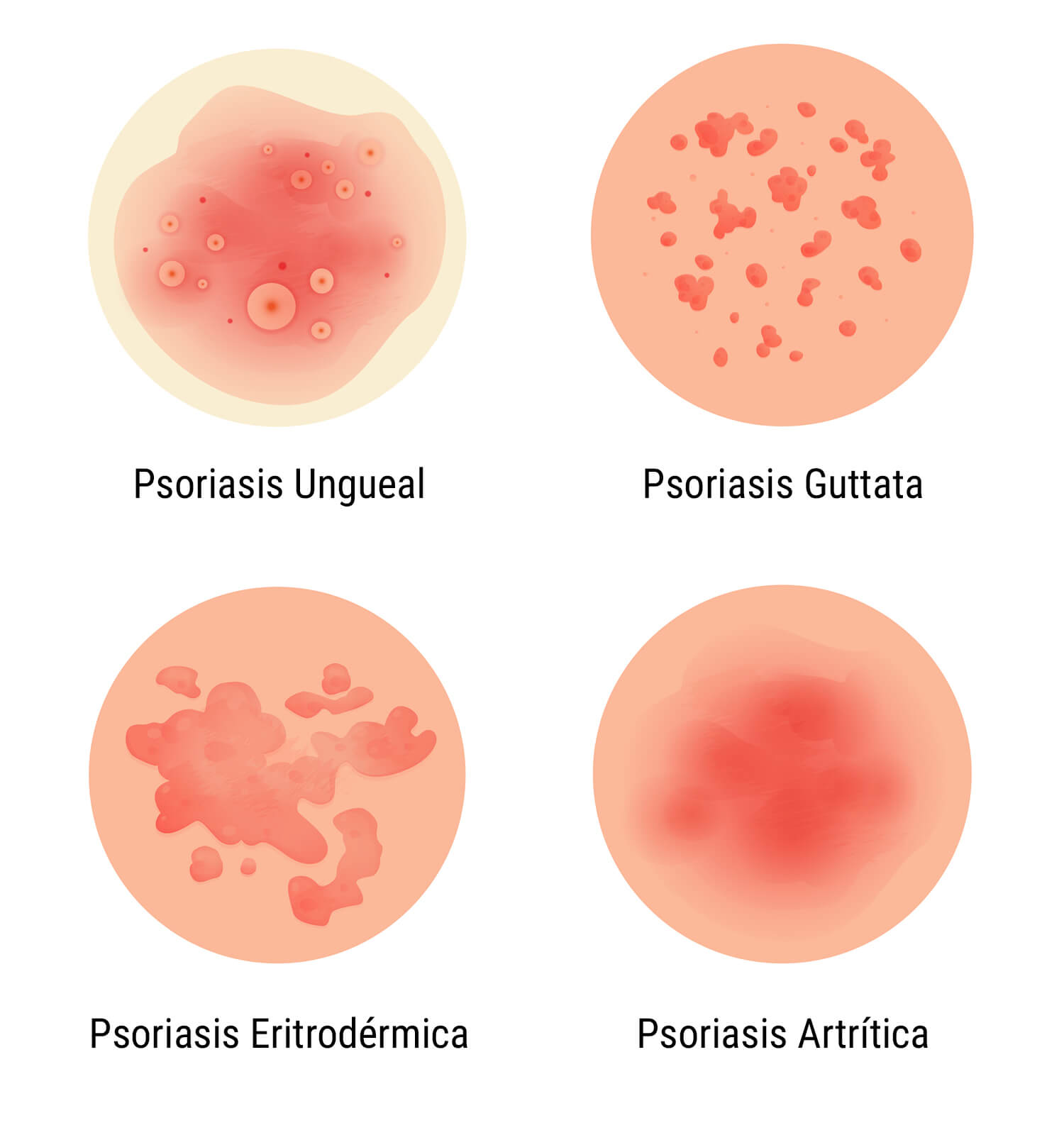 ¿Qué es la psoriasis? ¿Qué es la psoriasis?