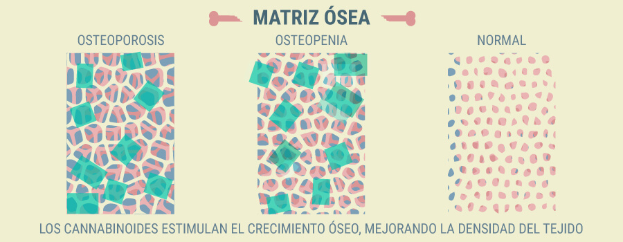 Osteoporosis CBD 
