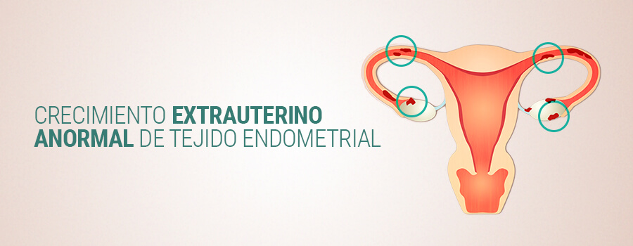 Endometriosis Y Cannabis En Mujer Endometriosis Y Cannabis En Mujer