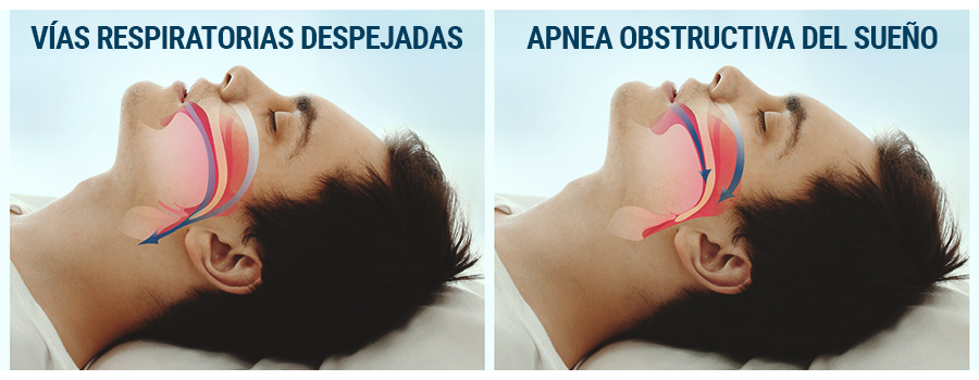 Apnea Del Sueño Vías Respiratorias