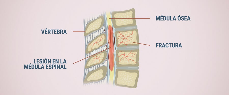 Daño A La Médula Espinal