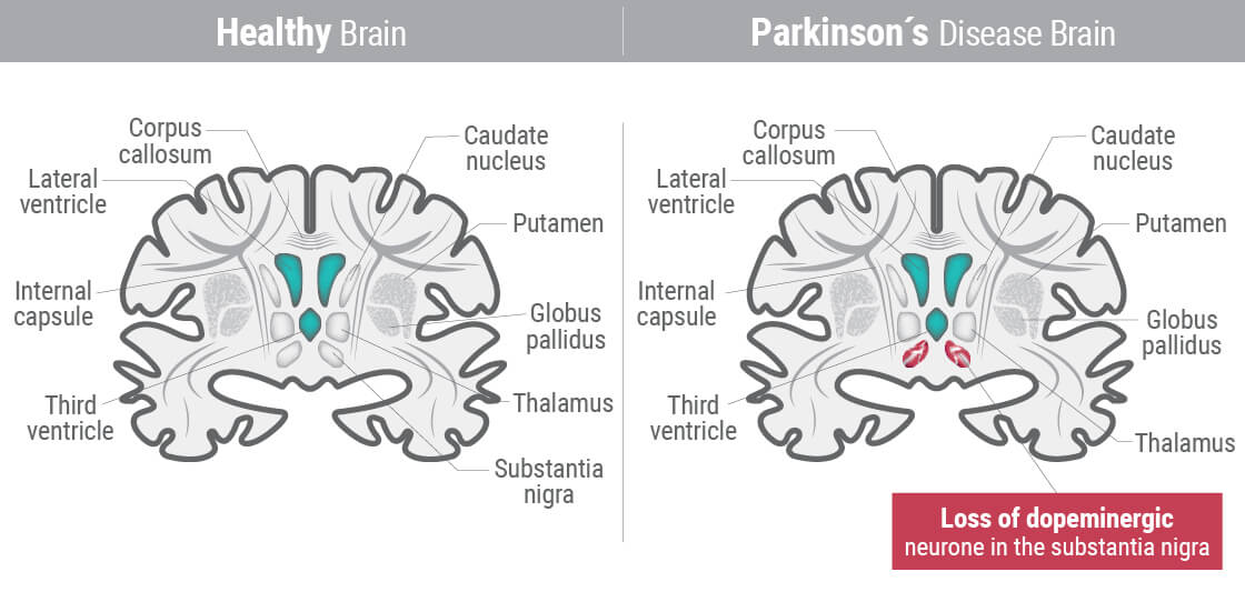 Parkinson's Disease Parkinson's Disease