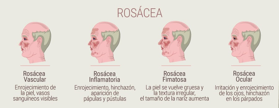Rosacea