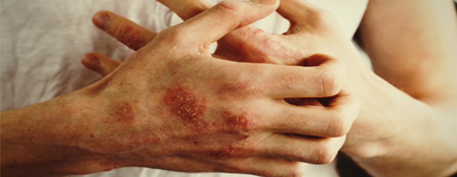 Eczema and allergies Eczema and allergies