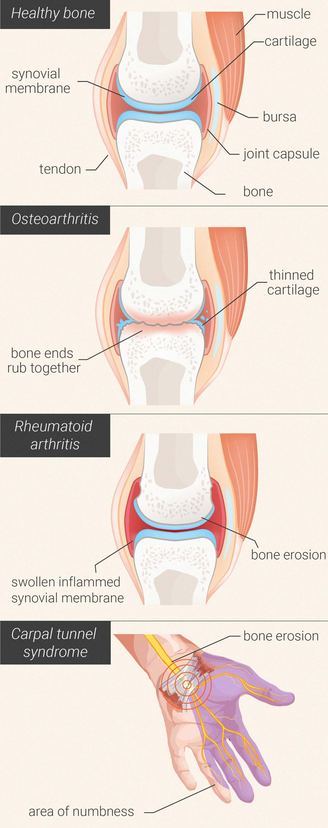 ¿Puede la hierba reducir el dolor e inflamación de la artritis?