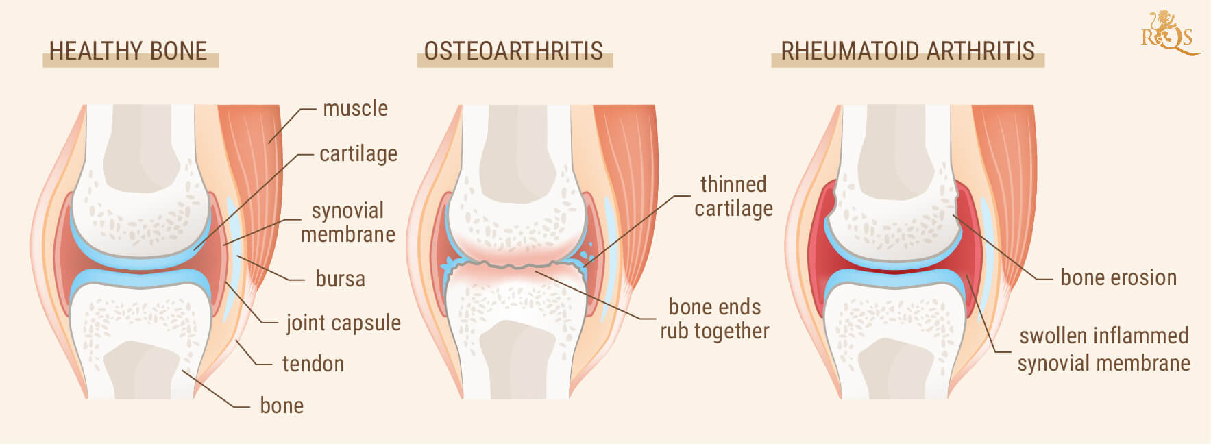 ¿Son iguales la artritis y el reumatismo? ¿Son iguales la artritis y el reumatismo?