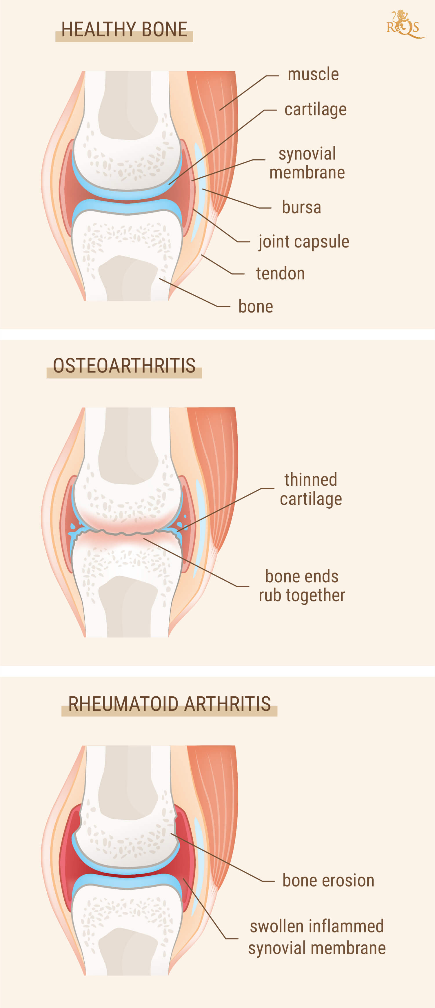 ¿Son iguales la artritis y el reumatismo? ¿Son iguales la artritis y el reumatismo?