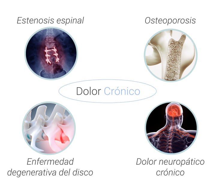 Causas comunes y tipos de dolor de espalda