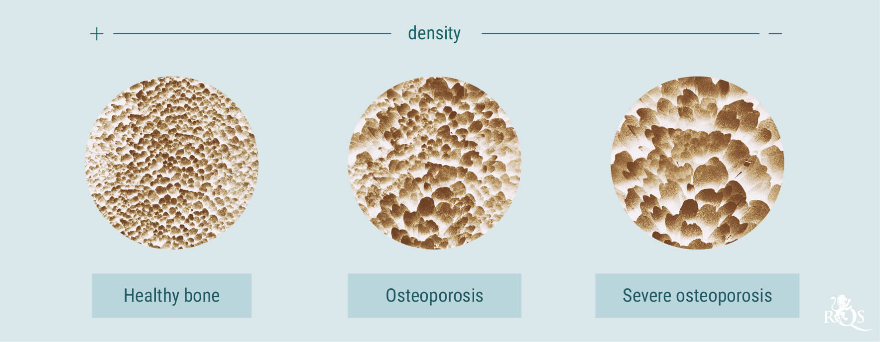 Cannabis y osteoporosis