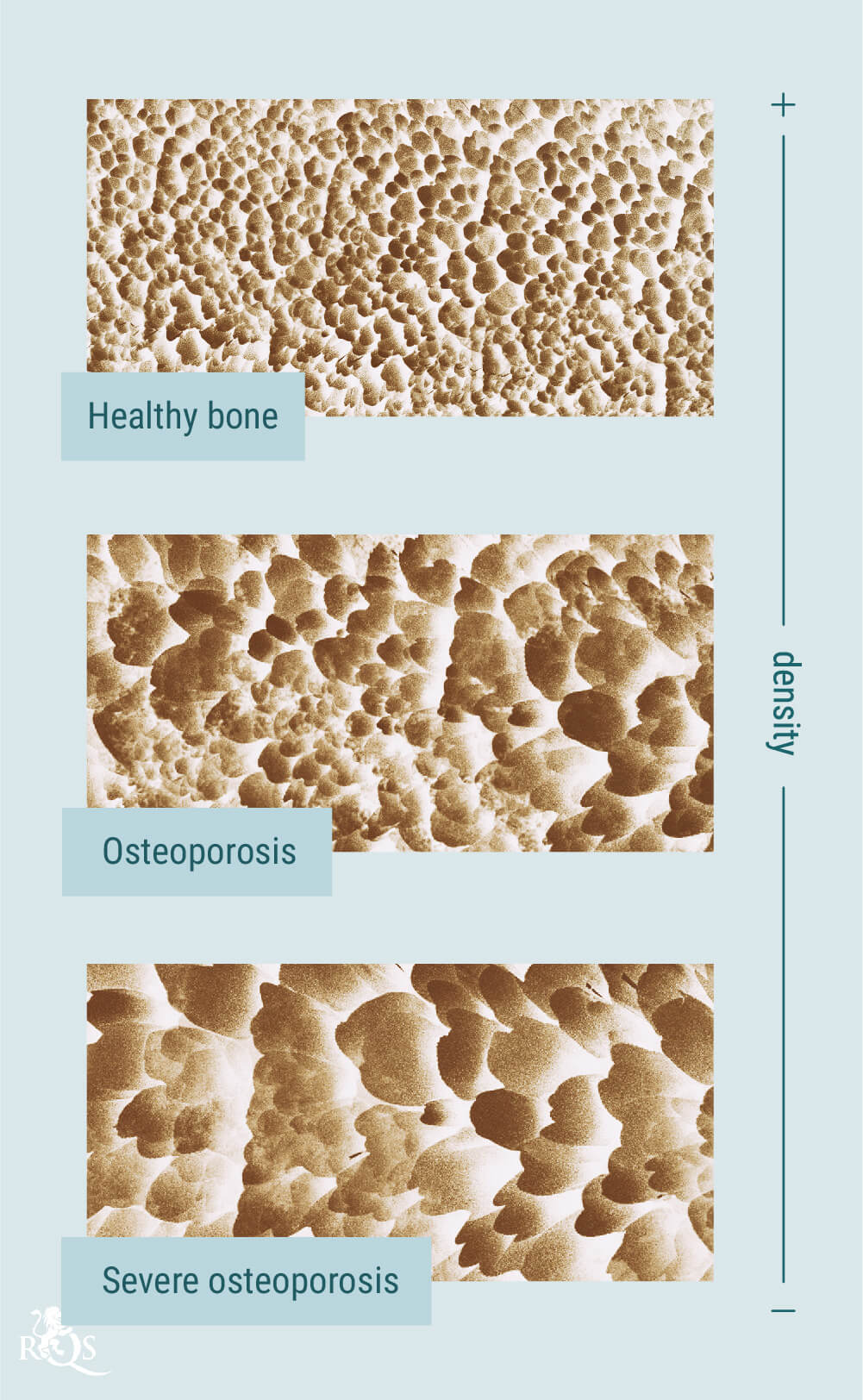 Cannabis y osteoporosis