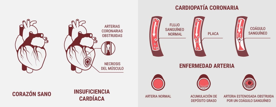 ¿Son lo mismo las enfermedades cardiovasculares y las enfermedades cardíacas?