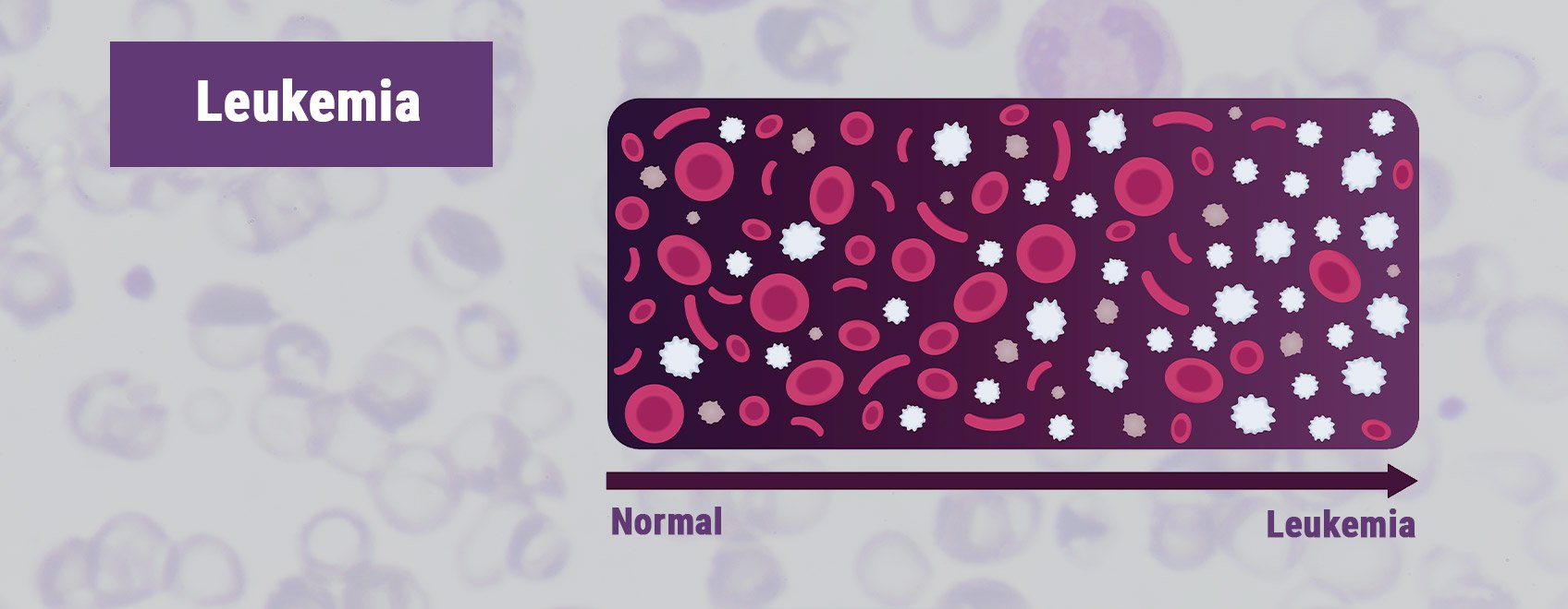 Leucemia