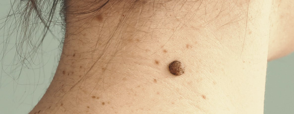 Síntomas del melanoma
