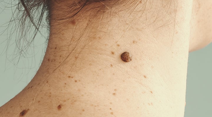 Síntomas del melanoma
