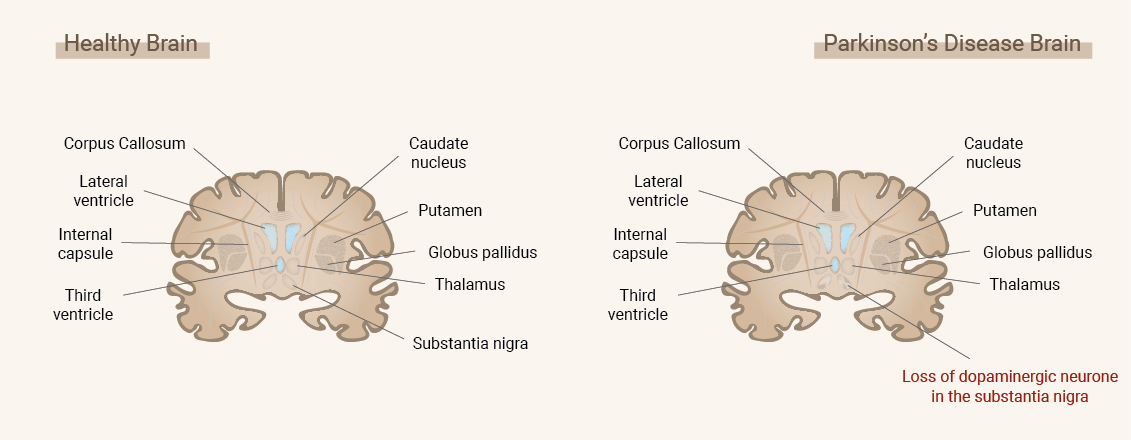 ¿Qué es la enfermedad de Parkinson? ¿Qué es la enfermedad de Parkinson?