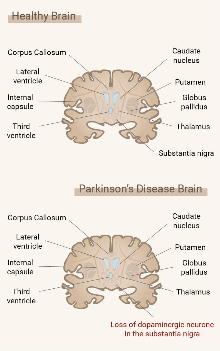 ¿Qué es la enfermedad de Parkinson? ¿Qué es la enfermedad de Parkinson?