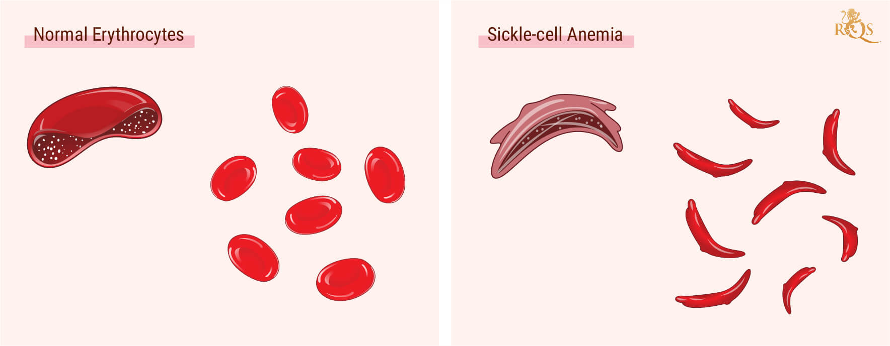 ¿Qué es la anemia de células falciformes? ¿Qué es la anemia de células falciformes?