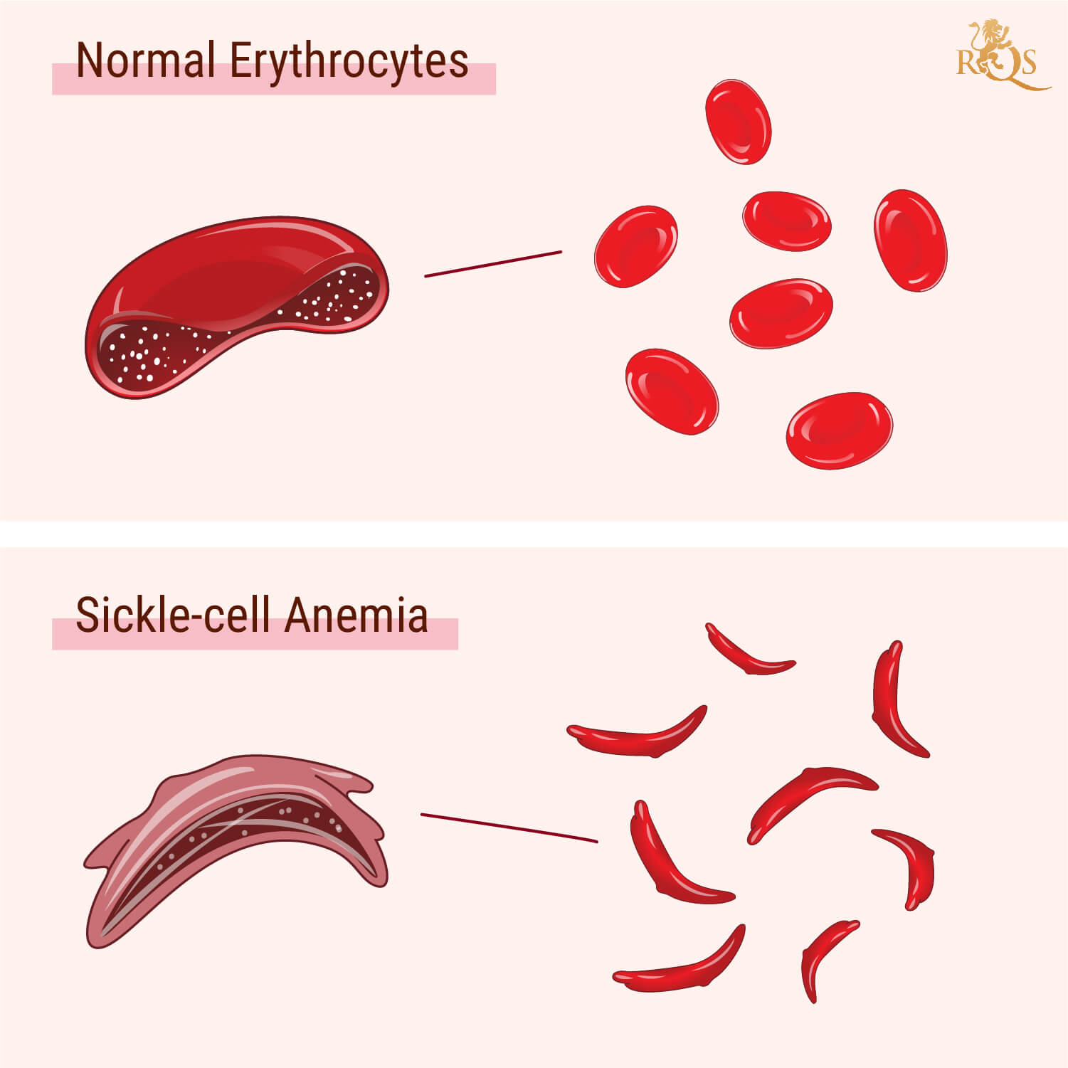 ¿Qué es la anemia de células falciformes? ¿Qué es la anemia de células falciformes?