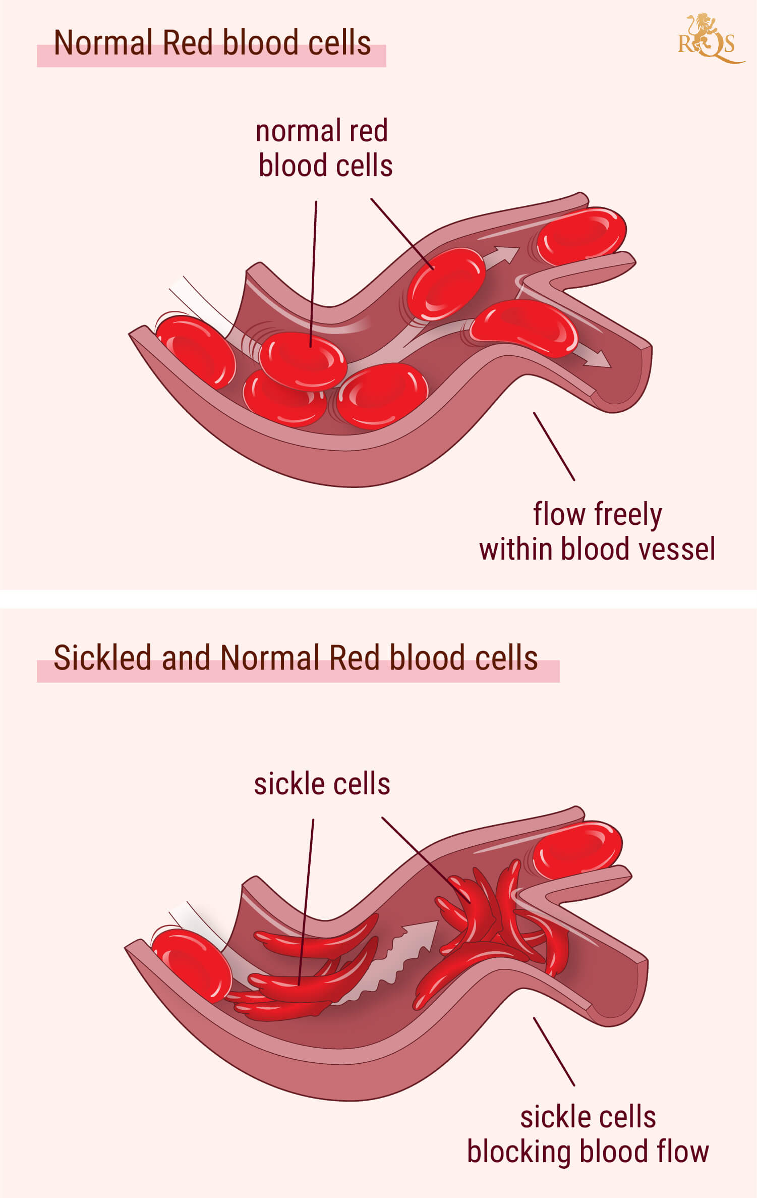 Marihuana para los síntomas de la anemia de células falciformes Marihuana para los síntomas de la anemia de células falciformes