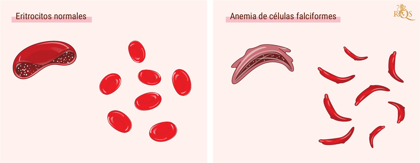 ¿Qué es la anemia de células falciformes?