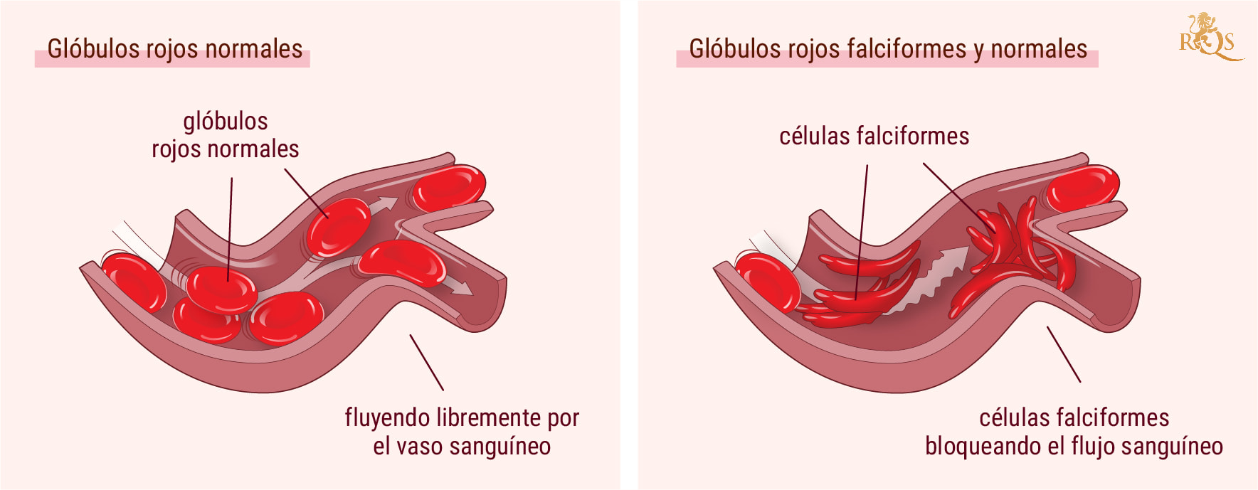 Marihuana para los síntomas de la anemia de células falciformes