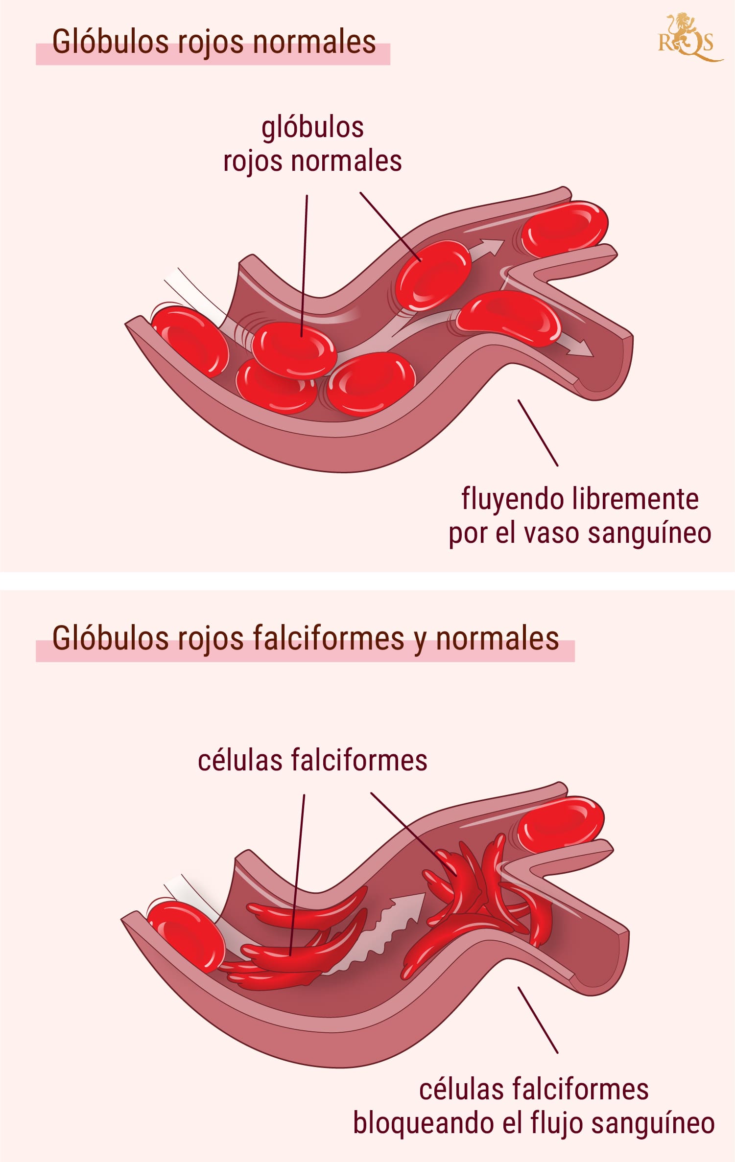 Marihuana para los síntomas de la anemia de células falciformes