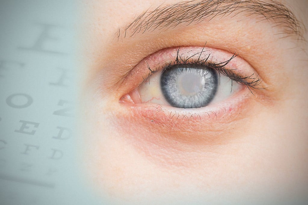 Marihuana y glaucoma: lo que necesitas saber