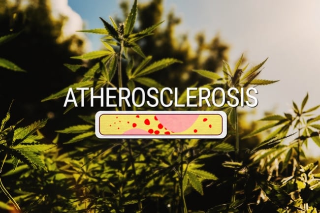 ¿Podría la marihuana tratar la ateroesclerosis?